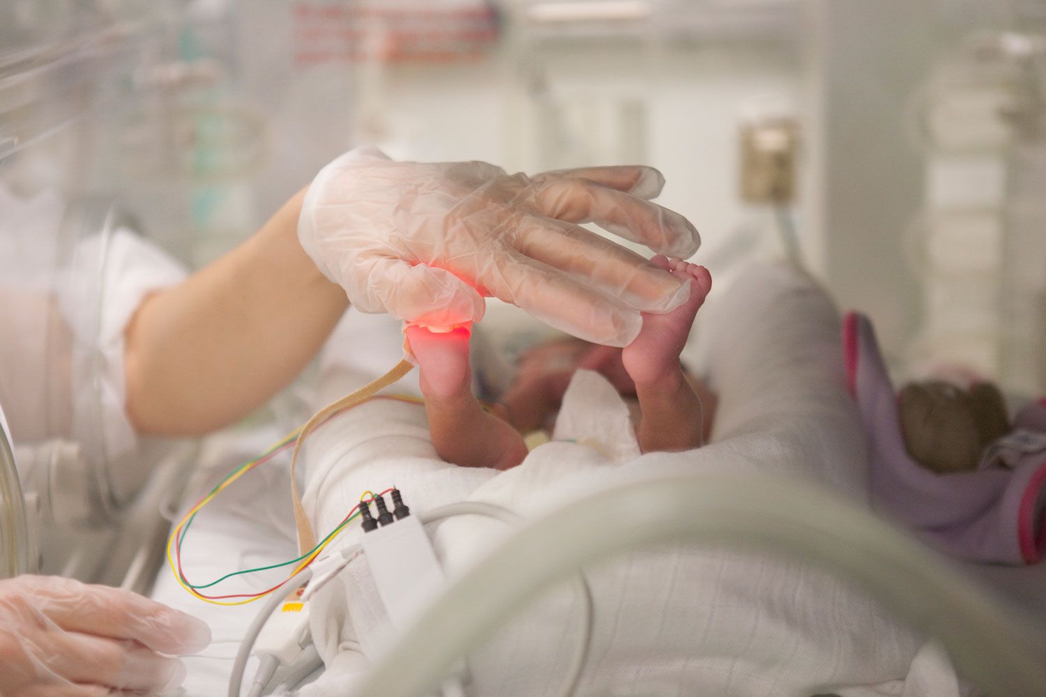 Image of a person's gloved hand stroking a premature baby's feet 