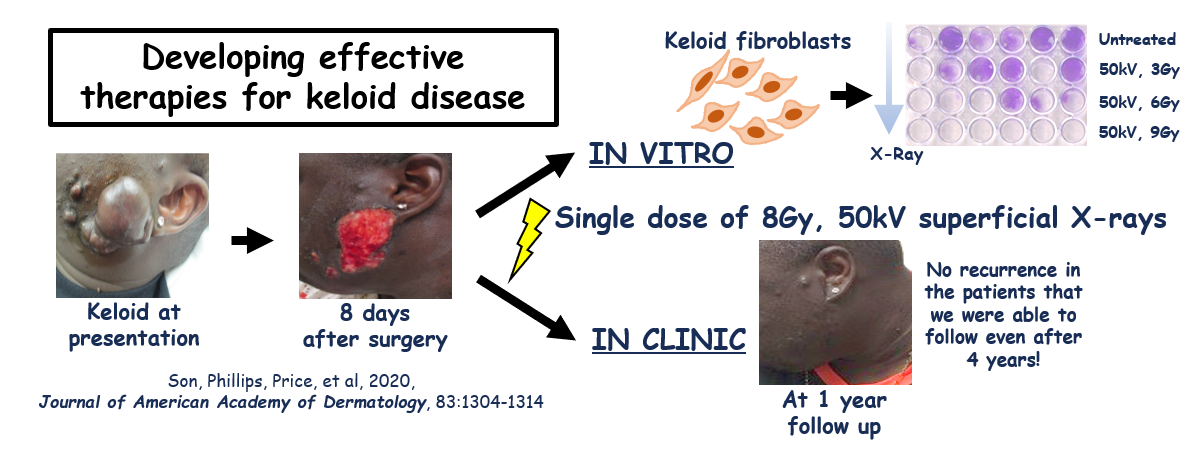 A single low dose of superficial radiation blocks keloid recurrence after surgery
