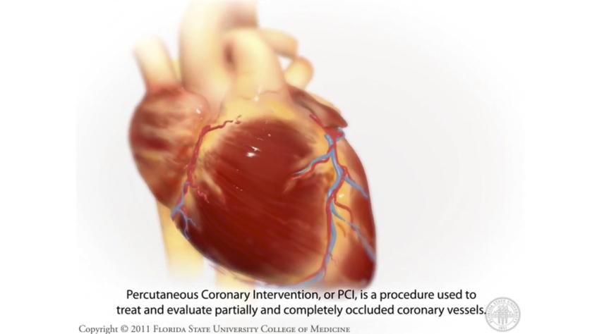 Percutaneous Coronary Intervention- Coronary Angioplasty