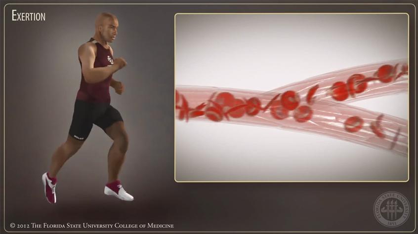 Sickle Cell Trait- Exertional Sickling in Athletes