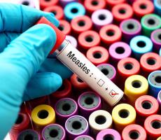 Measles