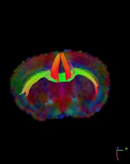 AN MRI tractography image of a mouse brain that has both ADHD and concussion